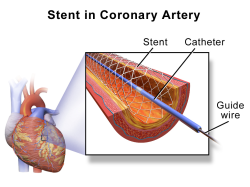 Stent in human coronary artery. (Wikimedia, Blausen gallery 2014) 